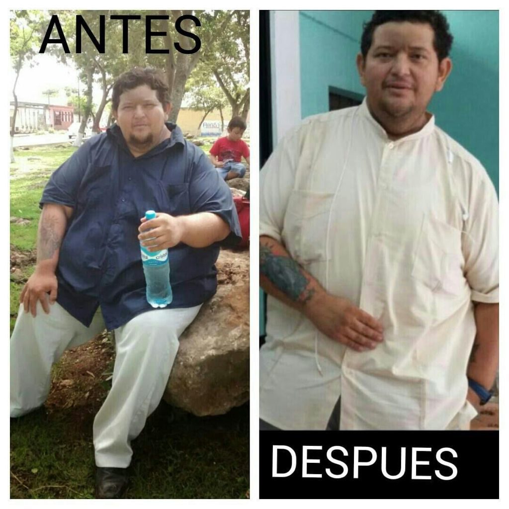 Israel Geyslher Molina Hernández antes y después de su cirugía